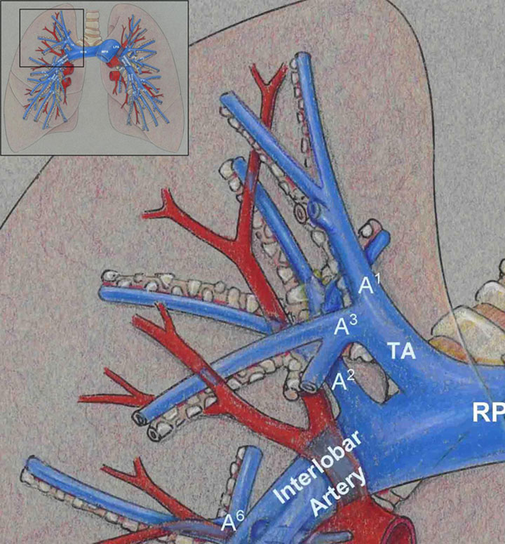 Ct Pulmonary Angiography 7707